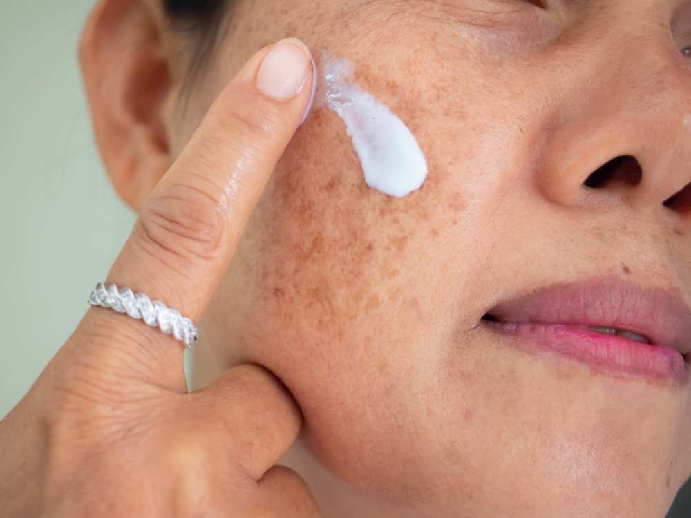 cách trị nám da mặt bằng kem dưỡng da