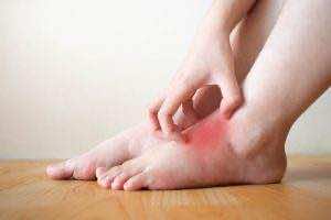 Viêm da cơ địa ở chân có khó điều trị không?